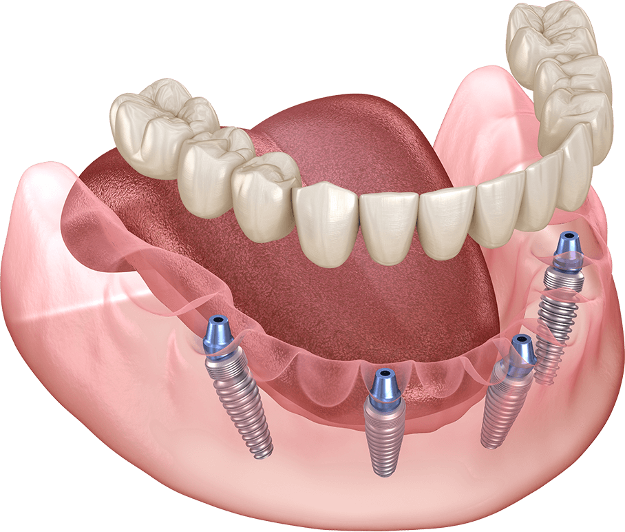 All-on-4/All-on-6(オールオンフォー/オールオンシックス)
